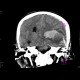 Intraparenchymal hemorrhage: CT - Computed tomography